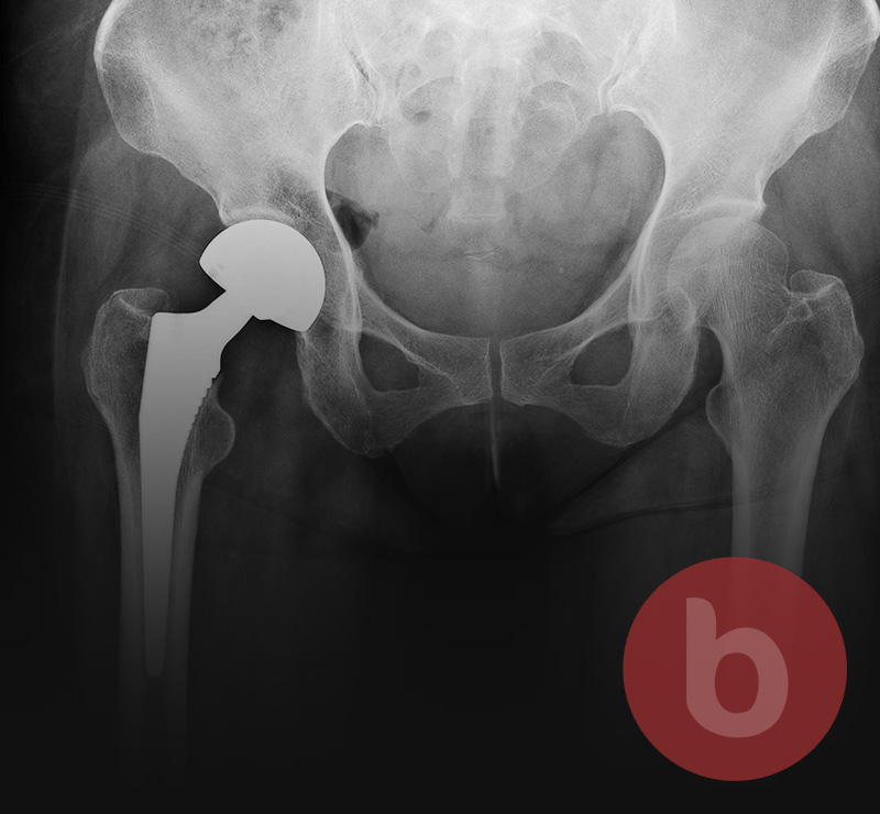 Depuy Hip Replacement